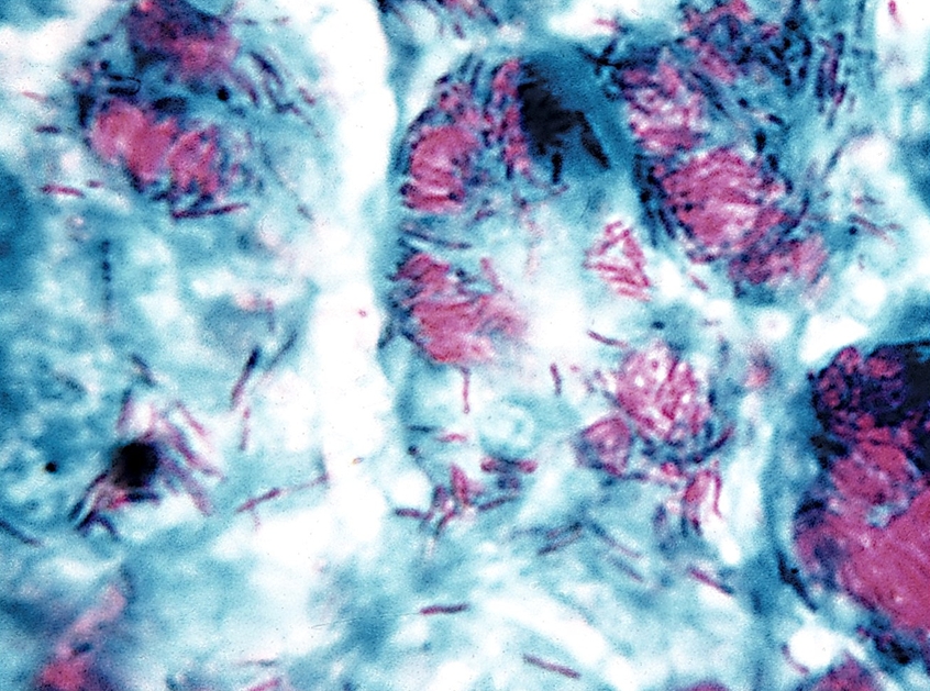 mycobacterium leprae acid fast