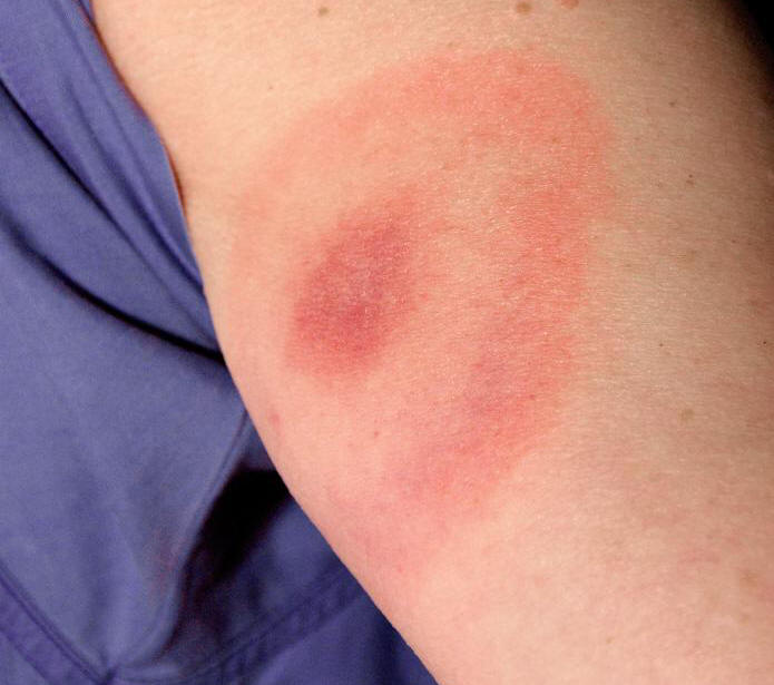 pathognomonic erythematous rash