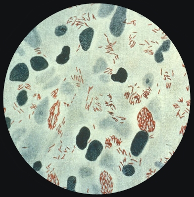 leprosy bacteria