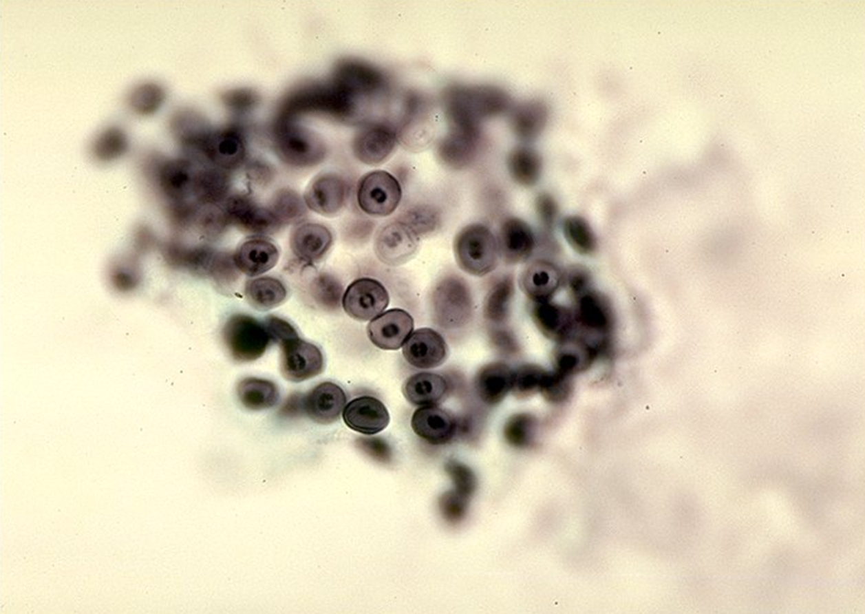 Пневмоцисты. Грибом Pneumocystis jirovecii. Pneumocystis (CARINII) jiroveci.