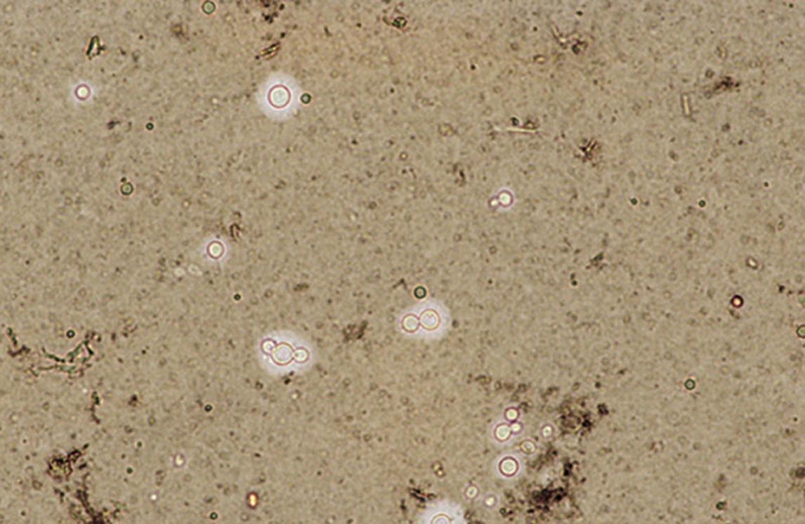 Image: India Ink Stain (Cryptococcus neoformans) - Merck Manuals